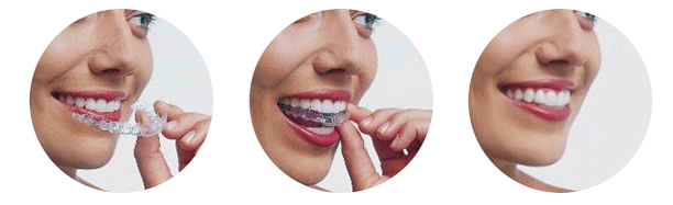 invisalign-aligners2