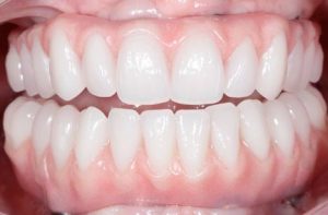 case1 after dentures