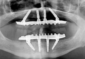 Xray of allon 4 implants case study