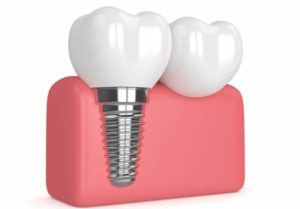 dental implant diagram