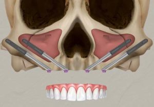 Zygomatic implants are placed in the cheekbone (Zygoma)