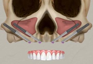 Zygomatic implants are placed in the cheekbone (Zygoma)