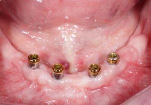 MIni implants in lower jaw