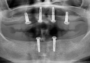 Xray of dental implants in place